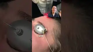 Best Laser for Acne Scars