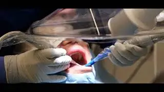 Aspirare in modo efficiente laerosol prodotto durante le procedure do igiene orale