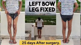 45 years old Man from Qatar fixed Left bow leg. planning for second bow leg surgery.