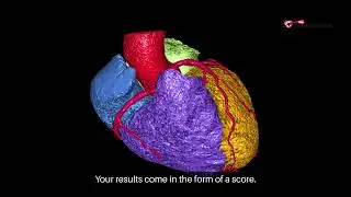 Hidden Heart Risks? Get Your CT Calcium Score Test in Waco, TX! 🩺💙