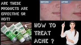do u want to solve ur acne problems? I HV a great solution for u all ....😇