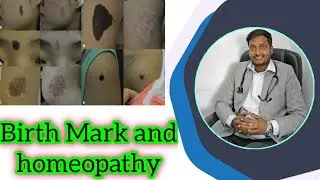 Nevus !! Birth Mark !! Homeopathic treatment !!Moles