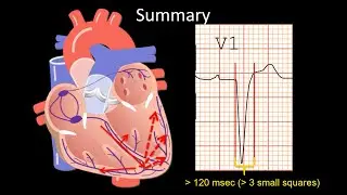 How to Read an ECG: Left Bundle Branch Block (LBBB)