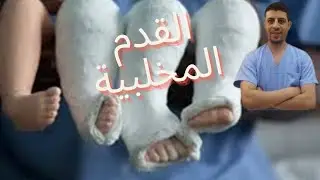 القدم الحنفاء|انواع القدم الحنفاء|القدم المخلبية للأطفال|تمارين القدم المخلبية|دكتور احمد حسن جمعه