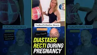 Diastasis Recti During Pregnancy 😱 #shorts