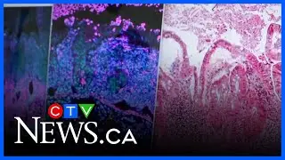 New AI analysis leads to scientific breakthrough in treatment of Crohn&rsquo;s disease