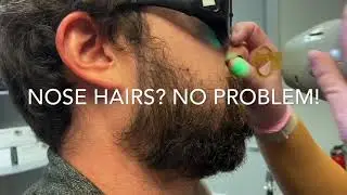 Laser hair removal for the nose