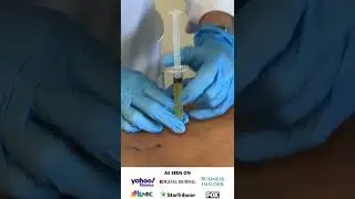 Platelet-rich plasma (PRP) injections at Peak Health in Kissimmee