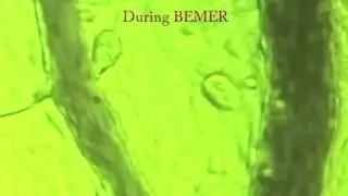 BEMER Micro Circulation Before and After