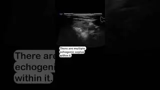 Acute on chronic thyroiditis on ultrasound