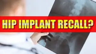 Hip Replacement: What steps should you take if your hip replacement has been recalled?