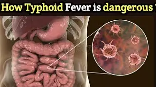 Typhoid fever symtoms and treatment 3D video(Hindi/Urdu)by saeed pharma