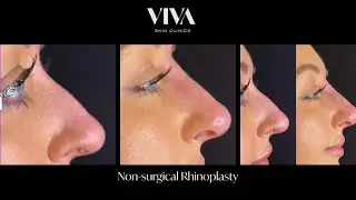 Non-surgical Rhinoplasty before & after 🙌👃 #fillers #dermalfillers #nonsurgicalrhinoplasty