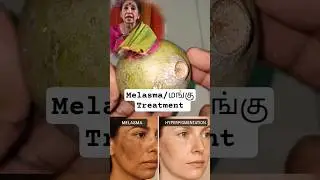 Treat Melasma & Hyperpigmentation Naturally with This Secret Ingredient! #melasma #tamilbeautytips
