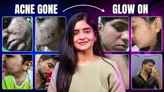 Acne kaise thik kare | How to remove old pimple| Best Acne treatment kit | Anti-acne products |