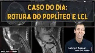 Rotura do Tendão Poplíteo e LCL