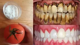 Comment blanchir naturellement vos dents jaunes || Blanchiment des dents &agrave; la maison en 3 minutes