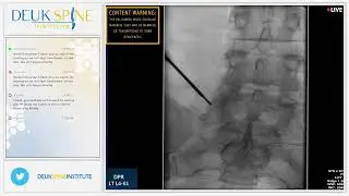 Lumbar Deuk Plasma Rhizotomy L4-S1 for Lower Back Pain from Facet Joint Arthropathy