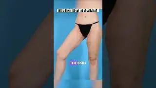 Can you reduce cellulite with a thigh lift?? #cellulite #thighlift #plasticsurgery