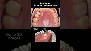 Braces pull impacted tooth #braces #dentist #orthodontist