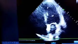 Ischemic Heart Disease with reduced Ejection Fraction 