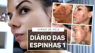 DIÁRIO DAS ESPINHAS (ACNE) SEM ROACUTAN