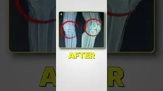 Knee Pain Gone! Real Patient Review After Knee Treatment | Dr. Vinit Yadav 🦵 | #Shorts