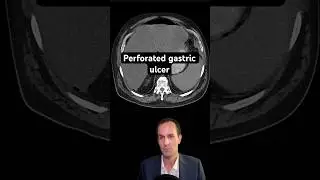 Abdominal CT Tutorials - Perforated gastric ulcer