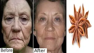 Wrinkle removal, instant natural face lift, homemade botox