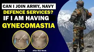 क्या Gynecomastia के Patients Army (Defence Services) में अनफिट हो जाते है?  | Dr. PK Talwar