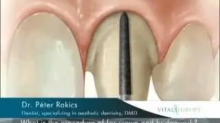 What is the procedure for crown and bridgework