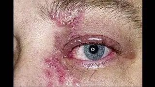 Dangers of Microblading