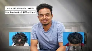 Best CHRK Treatment for Hair Regrowth | Anand&rsquo;s Journey with #VCare