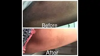 😮GET RID OF DARK INNER THIGHS | 1 WEEK🤫