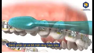 Cách Chăm Sóc và Vệ Sinh Răng Miệng Khi Niềng Răng Mắc Cài