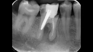 Post and Core in Dentistry by Dr.Khazane