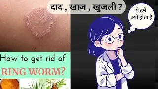 Ringworm Itching, Why Does It Happen? | Fungal Infection &ndash; Symptoms, Causes & Treatment | Health ...