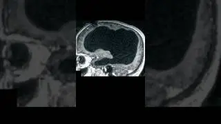 Man MISSING 90% of his BRAIN #sciencefacts #science #missing #brain