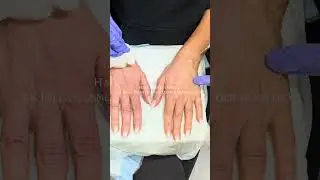 Hand Rejuvenation