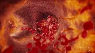 3D animation of a Clogged blood vessel due to a Sickle cell disease