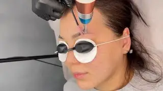 Eyebrow tattoo removal