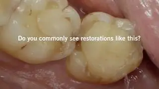 Tips & tricks on light curing to ensure long-lasting restorations (EN)