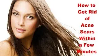 How to Get Rid of Acne Scars Within a Few Minutes | Remove Pimples With Home Remedies