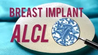 With Breast Implant Related ALCL, Trust the Experts