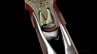 Extraction Upper Root Tips   GMX 69 Forceps