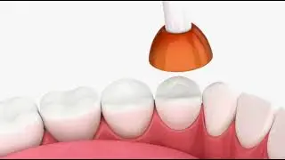 lower front  tooth decay treatment 480p sq x264