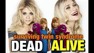 finding out i have surviving twin syndrome? | vanishing twin syndrome