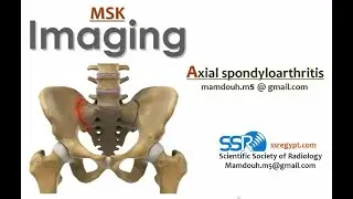 26- Axial spondyloarthritis imaging - Prof  Mamdouh Mahfouz