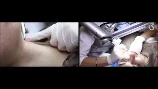 Удаление новообразований лазером| Самая эффективная методика