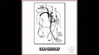 IABP HISTORY, FROM DIASTOLIC AUGMENTATION TO COUNTERPULSATION. #iabp #medicalstudent #nursing